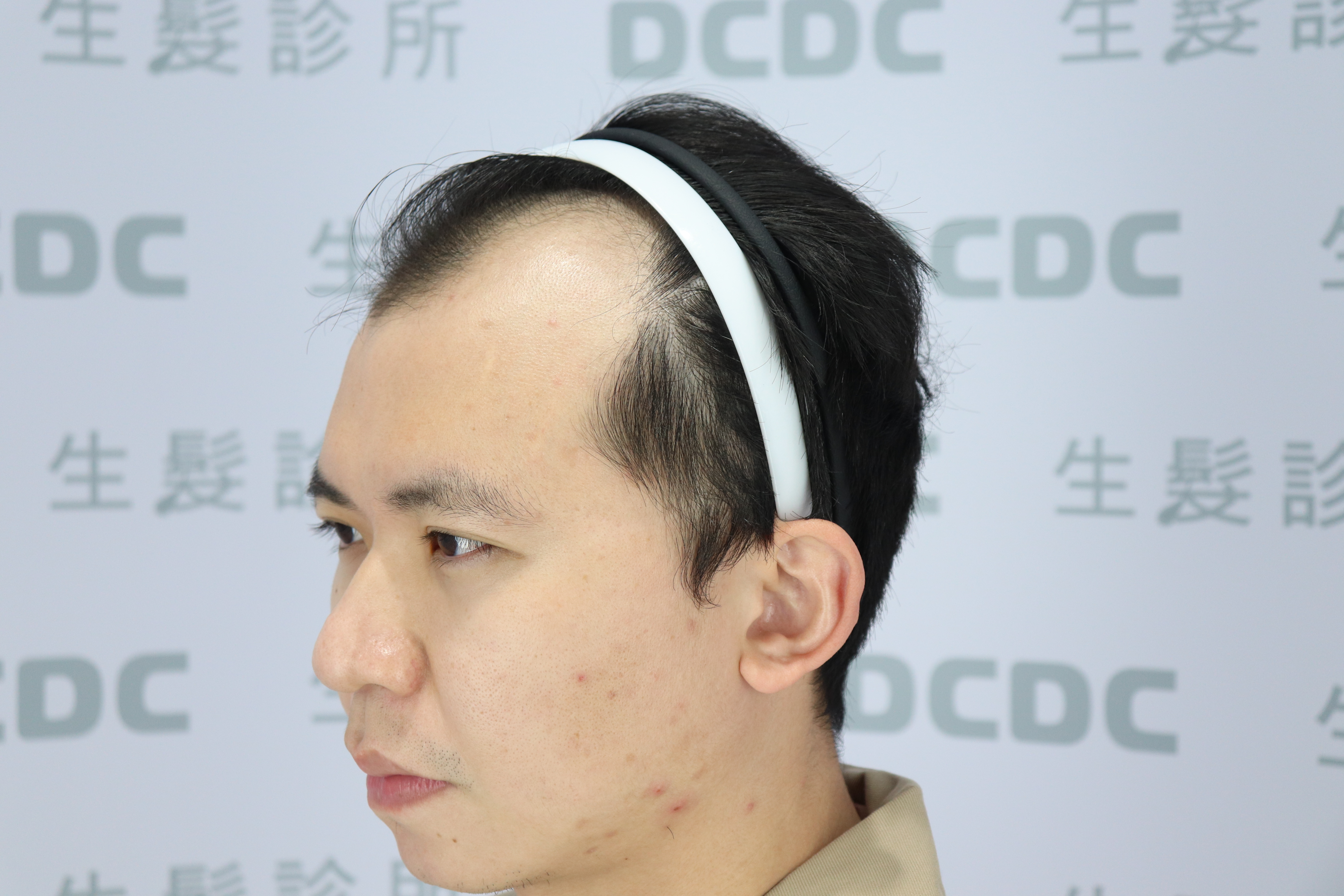 DCDC生髮診所-前額落髮嚴重範圍廣泛術前細節拍攝